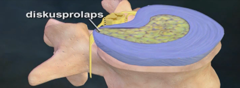 Symptomer på diskusprolaps